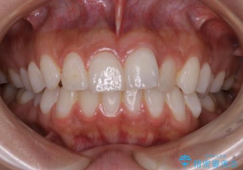 部分矯正とインビザラインを組み合わせて短期間での矯正治療の治療前