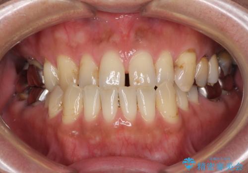 前歯の反対咬合をワイヤー矯正で改善して噛みやすくの症例 治療前