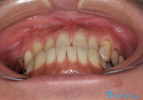 前歯の反対咬合をワイヤー矯正で改善して噛みやすくの治療前