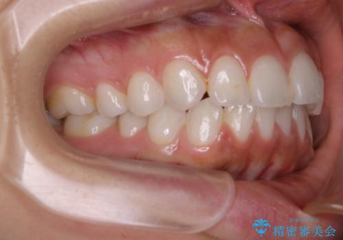 部分矯正とインビザラインを組み合わせて短期間での矯正治療の治療前