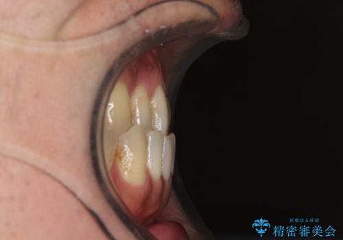 前歯の反対咬合をワイヤー矯正で改善して噛みやすくの治療前