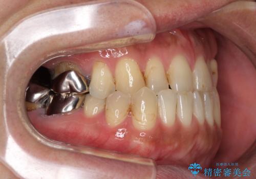 前歯の反対咬合をワイヤー矯正で改善して噛みやすくの治療前