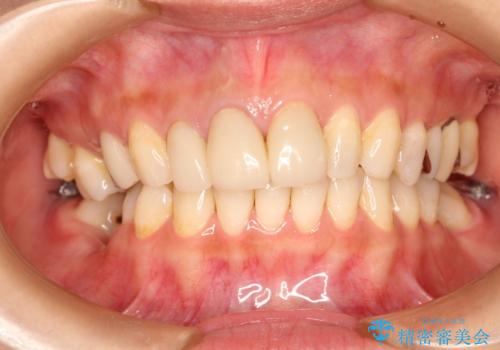 歯並びの改善とインプラントでのかみ合わせの回復 インプラント・セラミック・矯正全顎治療の治療中