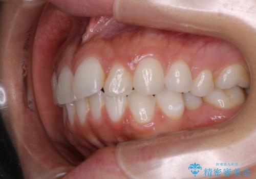 部分矯正とインビザラインを組み合わせて短期間での矯正治療の治療前