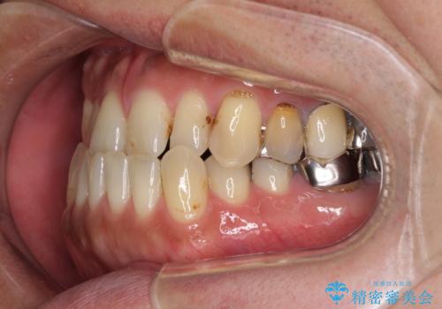 前歯の反対咬合をワイヤー矯正で改善して噛みやすくの治療前