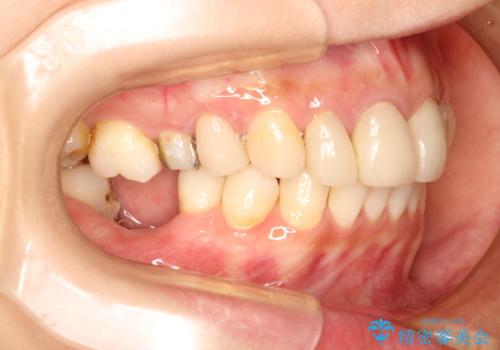 歯並びの改善とインプラントでのかみ合わせの回復 インプラント・セラミック・矯正全顎治療の治療中
