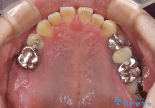 前歯の反対咬合をワイヤー矯正で改善して噛みやすくの治療前