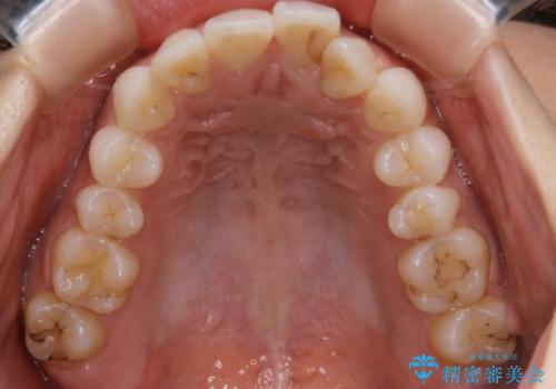 部分矯正とインビザラインを組み合わせて短期間での矯正治療の治療前