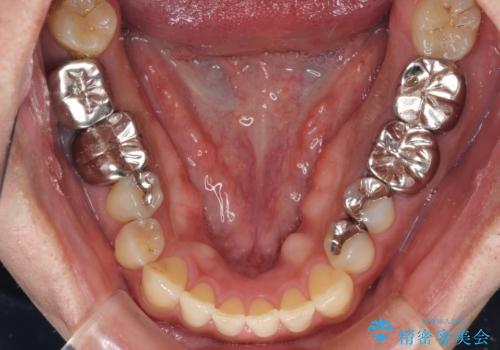 前歯の反対咬合をワイヤー矯正で改善して噛みやすくの治療前