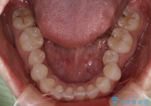 部分矯正とインビザラインを組み合わせて短期間での矯正治療の治療前