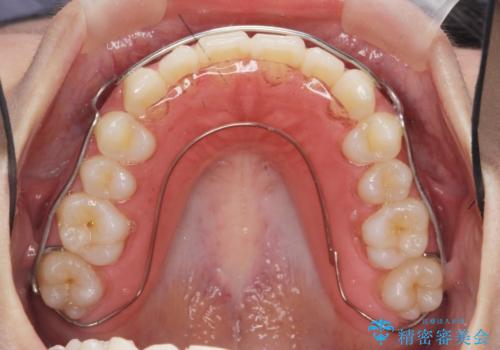 ガタつきの改善 マウスピース矯正治療の治療後