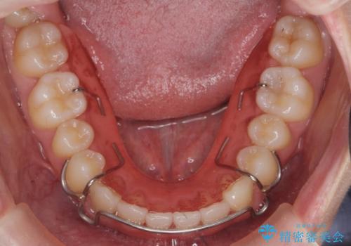 ガタつきの改善 マウスピース矯正治療の治療後