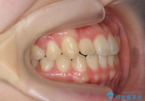 [ マウスピース矯正 ]  前歯のねじれを治したいの治療後
