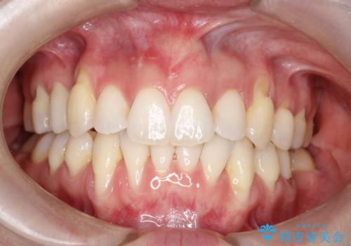 目立つ部位の歯茎がさがってきた　歯茎の移植で元の位置まで回復の治療後