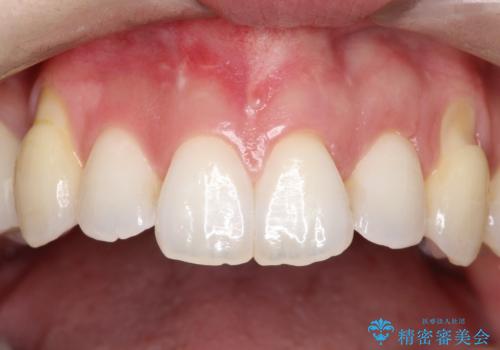 目立つ部位の歯茎がさがってきた　歯茎の移植で元の位置まで回復の治療後