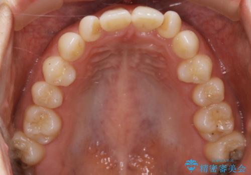 動きづらい前歯のねじれもマウスピース(インビザライン)で改善の治療前