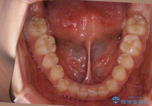 動きづらい前歯のねじれもマウスピース(インビザライン)で改善の治療前