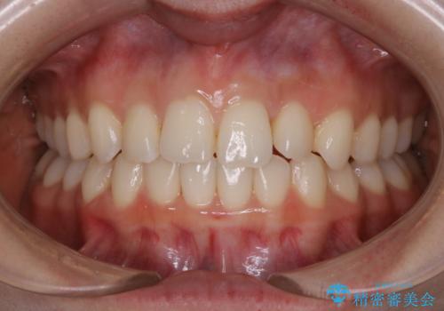 動きづらい前歯のねじれもマウスピース(インビザライン)で改善の治療中