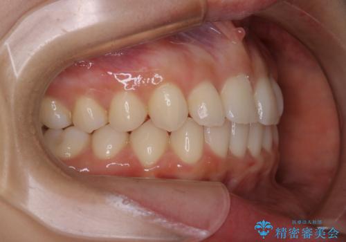 動きづらい前歯のねじれもマウスピース(インビザライン)で改善の治療中
