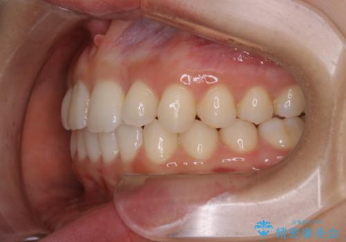 動きづらい前歯のねじれもマウスピース(インビザライン)で改善の治療後