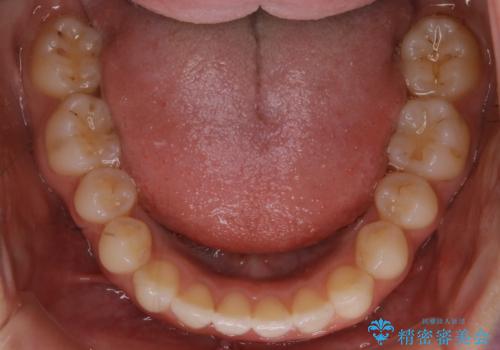 動きづらい前歯のねじれもマウスピース(インビザライン)で改善の治療中