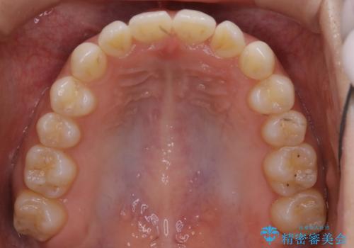 動きづらい前歯のねじれもマウスピース(インビザライン)で改善の治療中