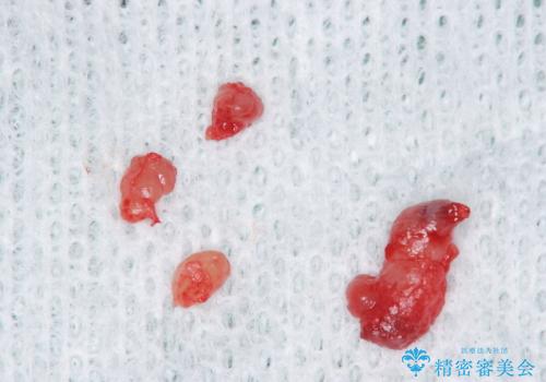 咬んでしまった後、唇に何かできた 粘液嚢胞摘出の治療中