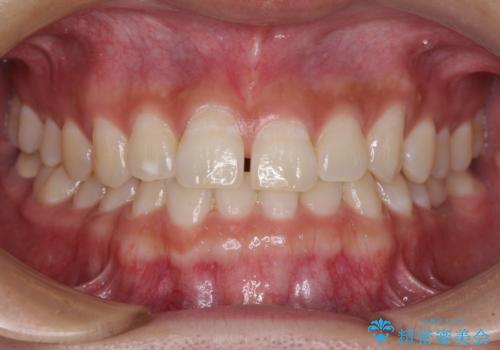 隙間の空いた前歯を治したい 上顎の部分矯正の症例 治療前