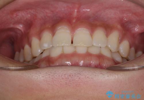 隙間の空いた前歯を治したい 上顎の部分矯正の治療前