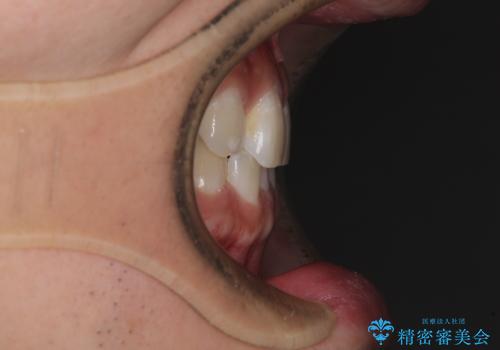 隙間の空いた前歯を治したい 上顎の部分矯正の治療前