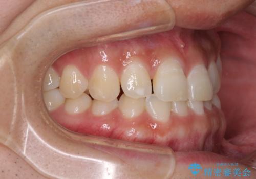 隙間の空いた前歯を治したい 上顎の部分矯正の治療前