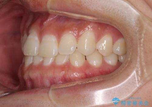隙間の空いた前歯を治したい　上顎の部分矯正の治療前