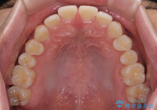 隙間の空いた前歯を治したい 上顎の部分矯正の治療前