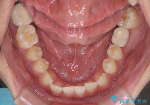 隙間の空いた前歯を治したい 上顎の部分矯正の治療前