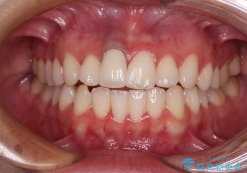 茶色になった前歯 オーダーメイドタイプのオールセラミッククラウンの治療後