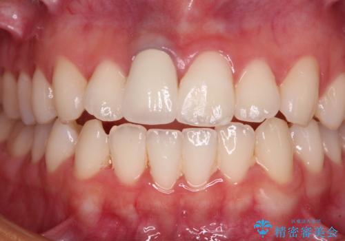 茶色になった前歯 オーダーメイドタイプのオールセラミッククラウンの治療後