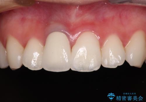 茶色になった前歯 オーダーメイドタイプのオールセラミッククラウンの症例 治療後