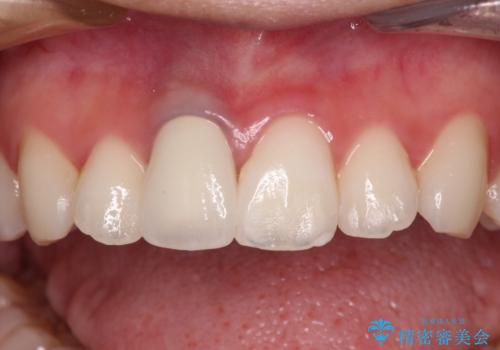 茶色になった前歯 オーダーメイドタイプのオールセラミッククラウンの治療後