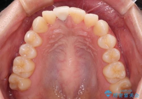 茶色になった前歯 オーダーメイドタイプのオールセラミッククラウンの治療後