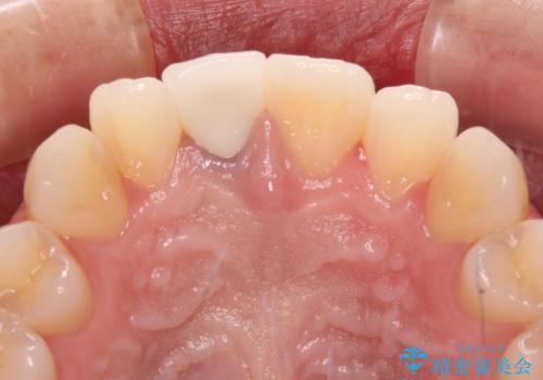 茶色になった前歯 オーダーメイドタイプのオールセラミッククラウンの治療後