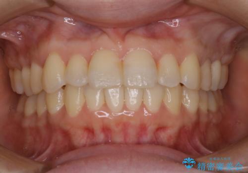 インビザラインで前歯の中心をお顔の中心に合わせるの治療後