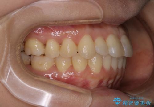 インビザラインで前歯の中心をお顔の中心に合わせるの治療後