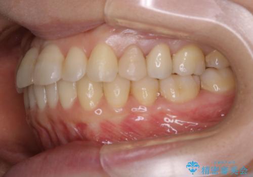 インビザラインで前歯の中心をお顔の中心に合わせるの治療後