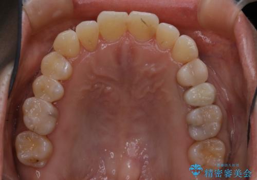インビザラインで前歯の中心をお顔の中心に合わせるの治療後