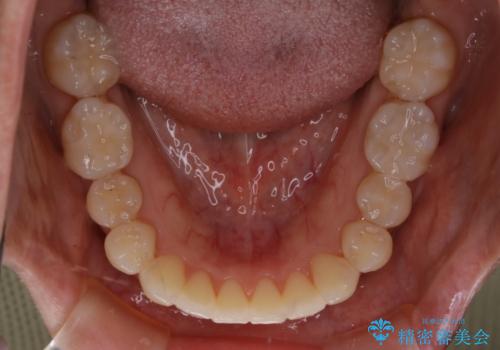 インビザラインで前歯の中心をお顔の中心に合わせるの治療後