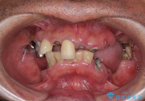 入れ歯の症例 治療前