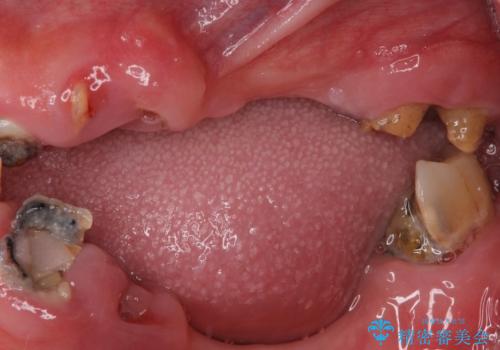 どこで咬んでいいのか分からない インプラント・オーバーデンチャーによる補綴治療の治療前