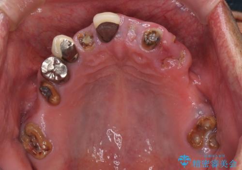 どこで咬んでいいのか分からない インプラント・オーバーデンチャーによる補綴治療の治療前