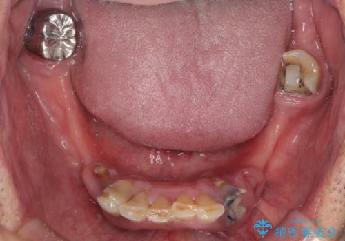 どこで咬んでいいのか分からない インプラント・オーバーデンチャーによる補綴治療の治療前