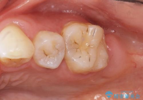 フロスを通すと臭い　歯と歯の間の虫歯　セラミックインレー　30代女性の症例 治療前